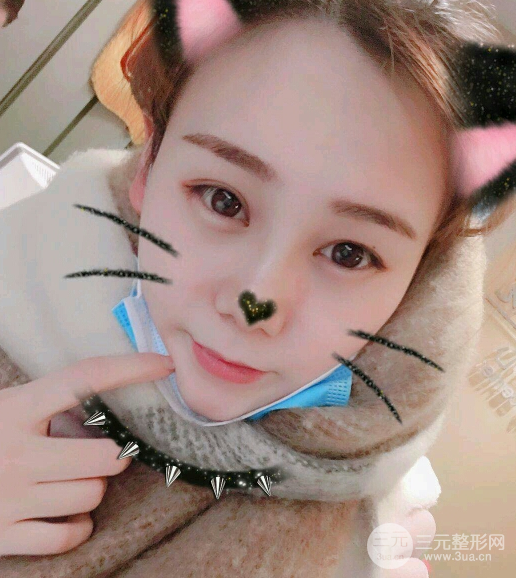 隆鼻整形三個月恢復(fù)真實圖片，做完土妹子變網(wǎng)紅辣