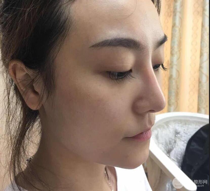 做了自體脂肪填充全臉，別人都以為我老公較為有錢