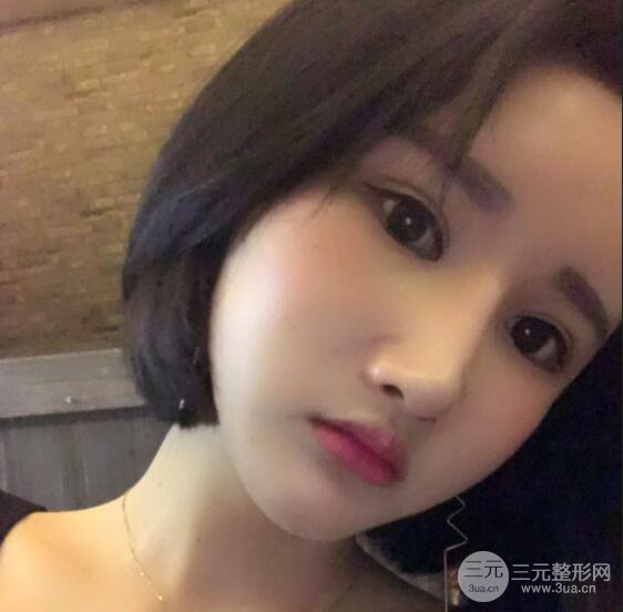 去下頜角+顴骨內(nèi)推手術(shù)三個(gè)月記錄，看大臉妹如何逆襲