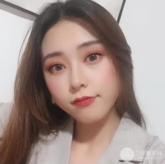 東莞君熠醫(yī)療美容李陵峰自體脂肪全臉填充恢復(fù)記錄