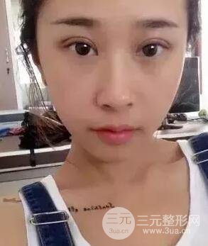 切開雙眼皮15天果圖