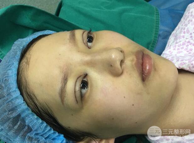 割雙眼皮多久會(huì)恢復(fù)