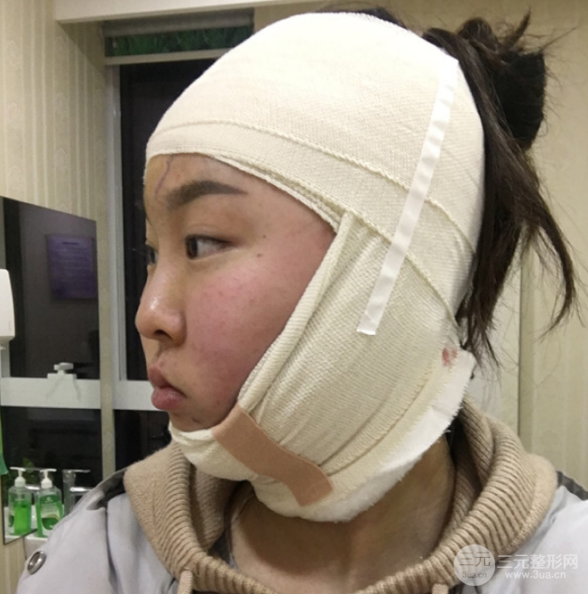 面部光纖溶脂三個月恢復記錄，妹子終于擺脫大臉盤子辣