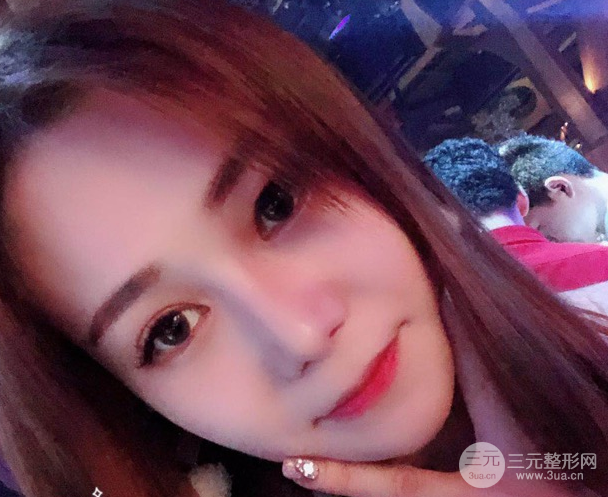 隆鼻整形三個月恢復(fù)真實圖片，做完土妹子變網(wǎng)紅辣