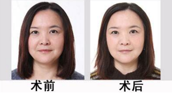 整形價(jià)格表，嫩膚除皺抗衰老整形前后對(duì)比圖
