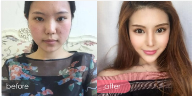 整形價(jià)格表,隆鼻和磨骨整形前后對(duì)比圖,整形多少錢