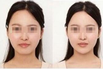 玻尿酸墊下巴價(jià)格、自體脂肪墊下巴價(jià)格
