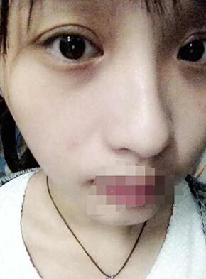 雙眼皮恢復(fù)過程經(jīng)歷