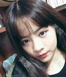 鼻翼縮小后鼻子終于變得秀麗了