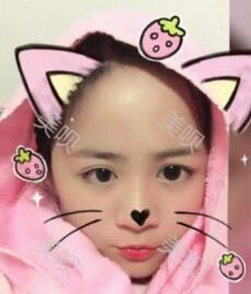 鼻翼縮小后鼻子終于變得秀麗了