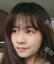 鼻翼縮小后鼻子終于變得秀麗了