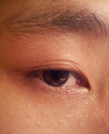 八大處靳小雷埋線雙眼皮一個多月了，果很好哦~~~