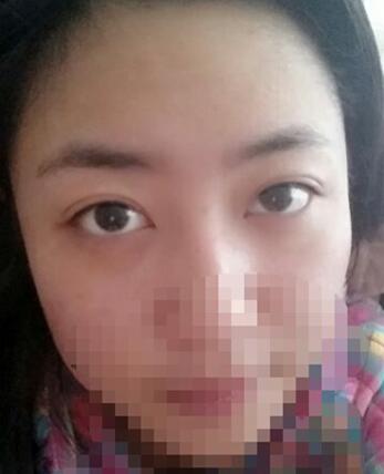 八大處靳小雷埋線雙眼皮一個多月了，果很好哦~~~