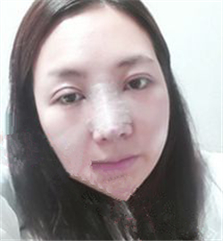 米揚麗格巫文云做的鼻部修復(fù)，恢復(fù)得不錯了