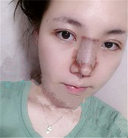 米揚麗格巫文云做的鼻部修復(fù)，恢復(fù)得不錯了