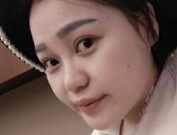 四川嬌點整形醫(yī)院的姜宇祿院長給我做的隆鼻整形，分享給大家看看