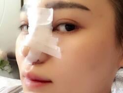 四川嬌點整形醫(yī)院的姜宇祿院長給我做的隆鼻整形，分享給大家看看