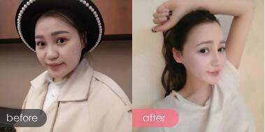 隆鼻整形，包括墊高鼻梁，縮小鼻翼，這是隆鼻整形前后對(duì)比圖