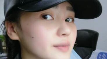 做完隆鼻整形后天天都盼著拆紗布，第3天終于拆了