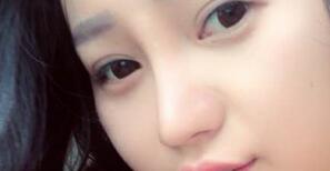 四川嬌點(diǎn)整形醫(yī)院姜宇祿院長(zhǎng)給我做的隆鼻整形