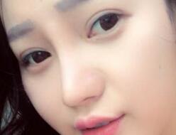 四川嬌點整形醫(yī)院的姜宇祿院長給我做的隆鼻整形，分享給大家看看