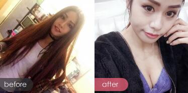 自體脂肪隆胸對(duì)比圖，四川嬌點(diǎn)醫(yī)學(xué)美容醫(yī)院的姜宇祿院長(zhǎng)那里做自體脂肪豐胸手術(shù)