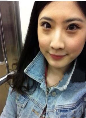 重慶愛(ài)思特鄭東學(xué)做的駝峰鼻矯正變美了