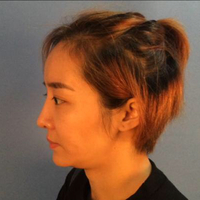 自體脂肪面部填充后我的部看上去好自然宛若天生