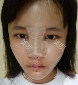 自體耳軟骨隆鼻后終于擁有滿意的鼻子了