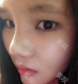 自體耳軟骨隆鼻后終于擁有滿意的鼻子了