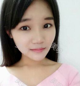 自體耳軟骨隆鼻后終于擁有滿意的鼻子了