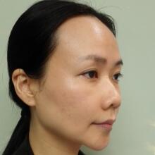 面b提升手術價格和真人案例