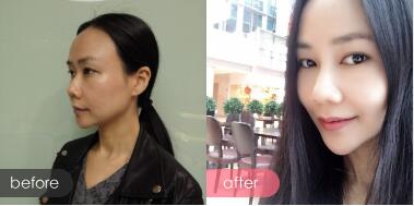 面部緊致提升前后對比圖
