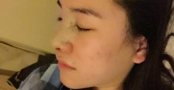 隆鼻整形術后恢復圖