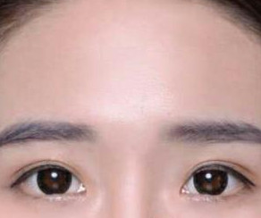 鄭東學(xué)做的雙眼皮果你來(lái)評(píng)價(jià)