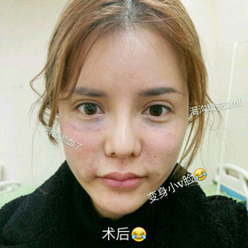 埋蛋白線.提升面部對(duì)比圖片，顏值嘩嘩嘩的往上漲!!!