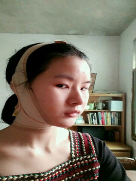 自體脂肪填充下巴前后對(duì)比圖，進(jìn)來看看就知道啦!