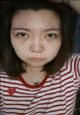 激光去眼袋后，整個人都年輕了不少啊!