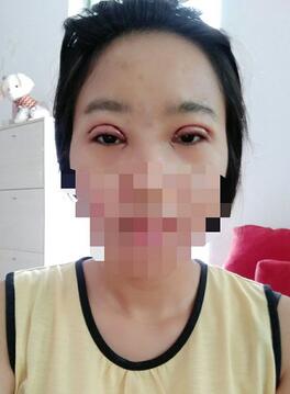 8.15號(hào)割的雙眼皮 感謝慕醫(yī)生