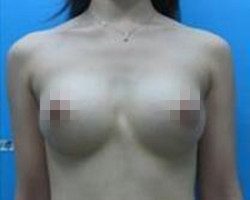 我在北京藝星醫(yī)療美容醫(yī)院自體脂肪隆胸真實經(jīng)歷