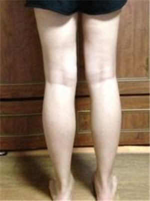 大腿吸脂后的長腿美女就是我