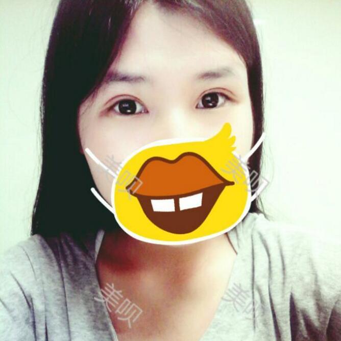 我做了切開雙眼皮術(shù)后果很好哦