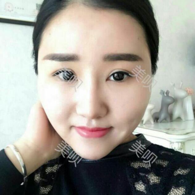 自體脂肪豐太陽穴后整個臉變得好有立體感太美了