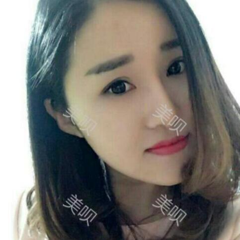 自體脂肪豐太陽穴后整個臉變得好有立體感太美了