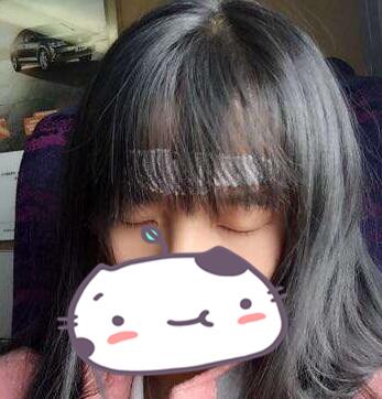 成都玉之光發(fā)際線種植 果不錯~