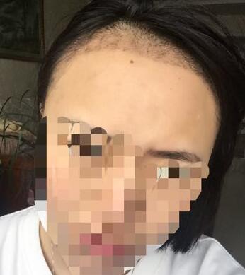 成都玉之光頭發(fā)移植 果杠杠的~