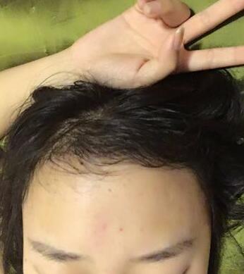 成都玉之光頭發(fā)移植 果杠杠的~