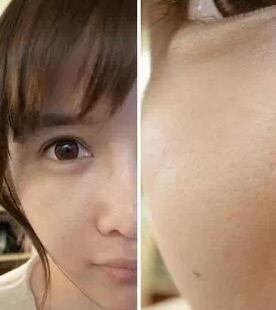 成都玉之光激光嫩膚經(jīng)歷 愛美的MM一定要看