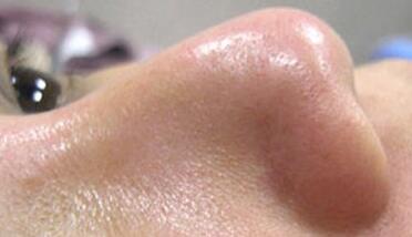 成都玉之光做了杏仁酸換膚 皮膚真的凈白無瑕了