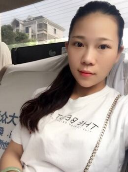 激光去雀斑后皮膚干凈白皙多了，青島華韓汪曉波做的